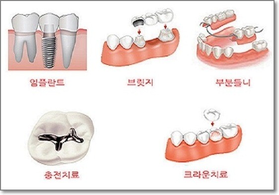 치아치료종류